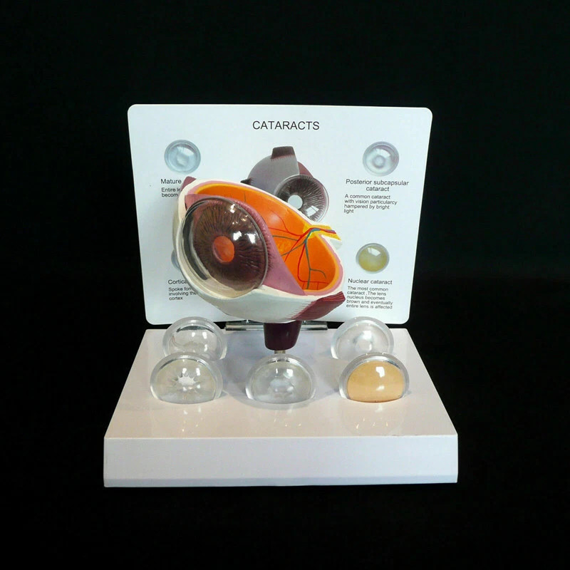 Anatomical Model of Human Cataract and Eye Disease-Medical Pathology ...